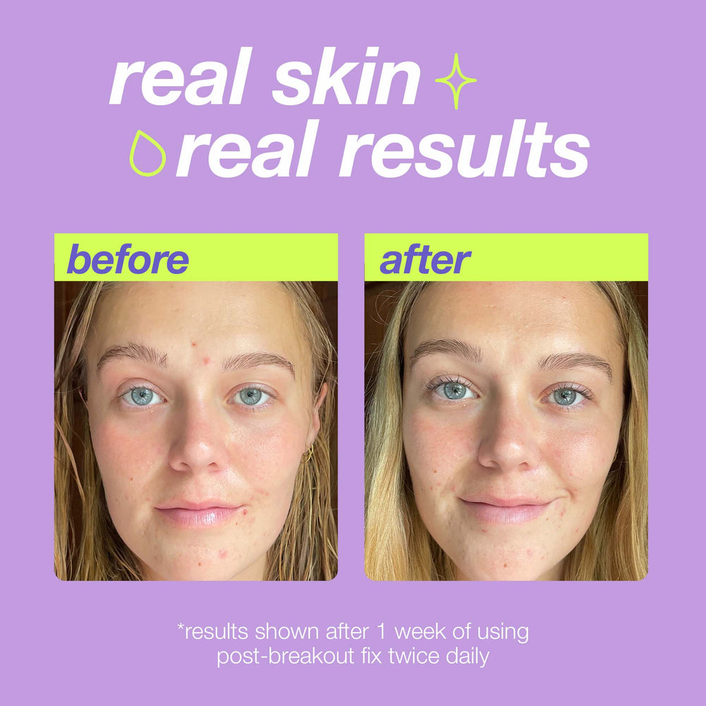Before and after comparison of a person's face with text 'real skin real results' on a purple background.